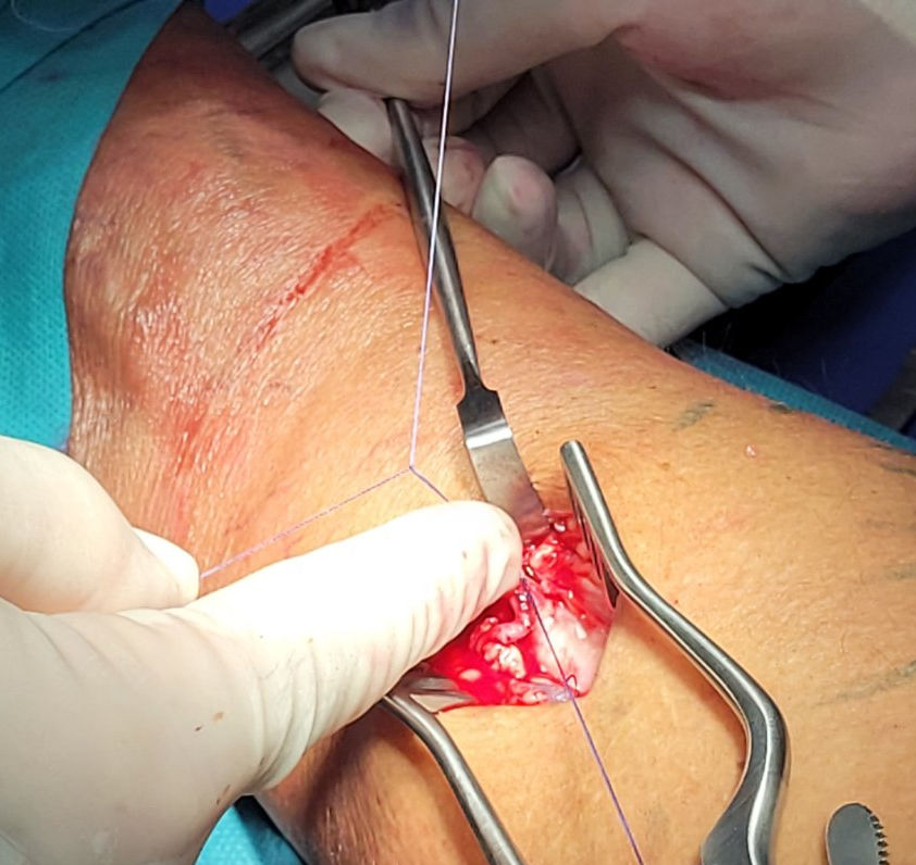 Najboljši dolgoročni način zdravljenja prebodne vene ostaja kirurška operativna tehnika.